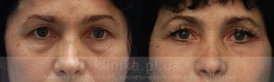 Blepharoplasty before and after operation, photo 7