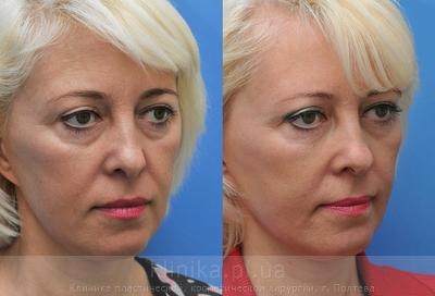 Face lipofilling before and after operation, photo 6