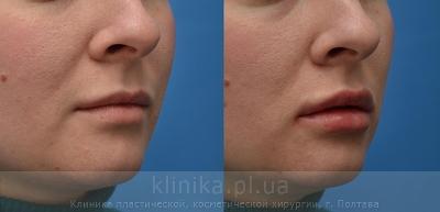 Contour correction before and after operation, photo 2