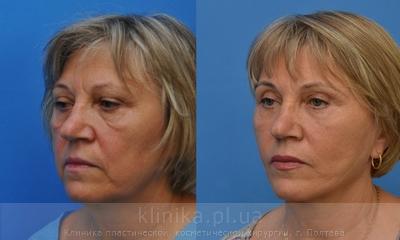 Facelifting before and after operation, photo 4
