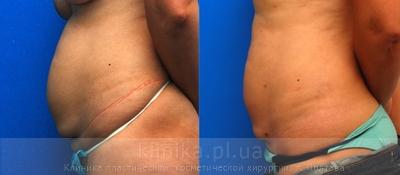 Liposuction before and after operation, photo 4