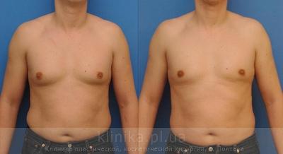 Treatment of gynecomastia before and after operation, photo 1