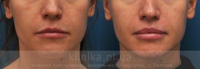 Surgical correction of the shape and volume of the lips (chalinoplasty) before and after operation, photo 8
