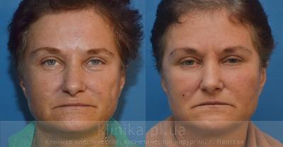 Face lipofilling before and after operation, photo 4