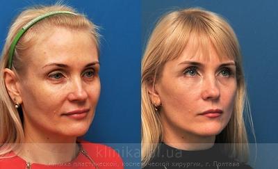 Facelifting before and after operation, photo 6