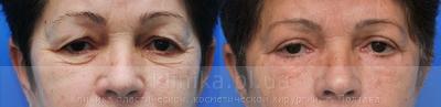 Blepharoplasty before and after operation, photo 2