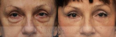 Blepharoplasty before and after operation, photo 3