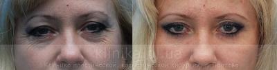 The correction of mimic wrinkles. before and after operation, photo 5