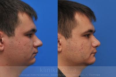 Correction of the tip and wings of the nose before and after operation, photo 8