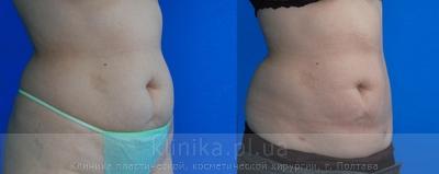 Liposuction before and after operation, photo 5