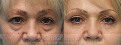 Blepharoplasty before and after operation, photo 3
