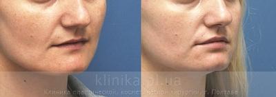 Хірургічні методи корекції форми та об'єму губ (Хейлопластика) до і після операції, фото 5