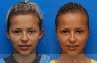 Otoplasty before and after operation, photo 8