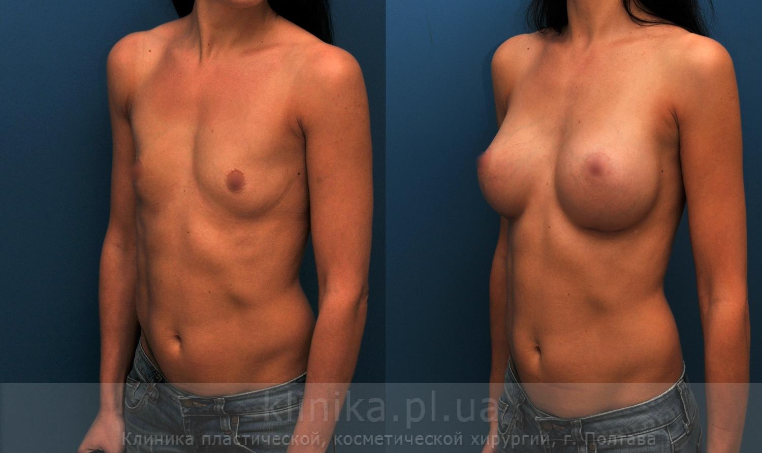 гормон для роста груди у женщин фото 112