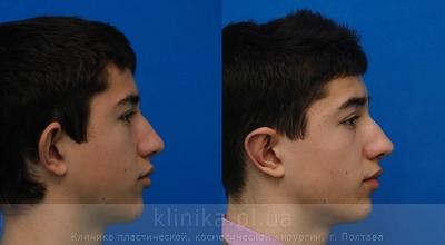 Пластика ушных раковин (отопластика) до и после операции, фото 1