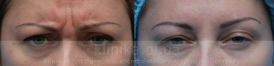 The correction of mimic wrinkles. before and after operation, photo 2