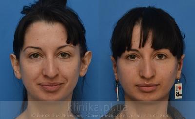 Otoplasty before and after operation, photo 1