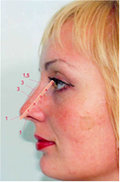 nose surgery, rhinoplasty nose