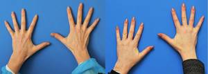 Lipofilling of the hands