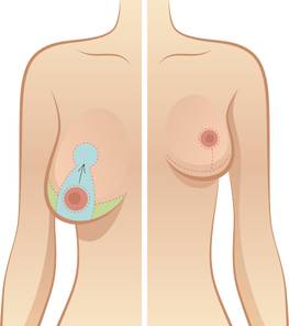 Особенности увеличения груди при инволюции молочных желез